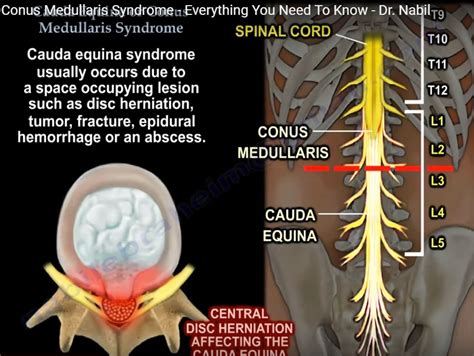 difference between cauda equina and conus medullaris